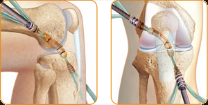 New Anterior Cruciate Ligament Surgery